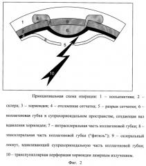 Способ лечения регматогенной отслойки сетчатки (патент 2244530)