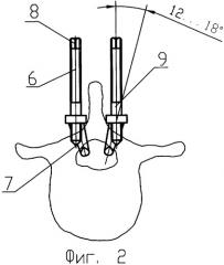 Крючок для крепления эндоустройств (патент 2329001)