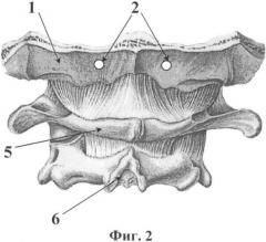 Способ фиксации шейно-затылочной области позвоночника (патент 2342915)