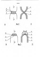 Устройство для формирования культи кишечника (патент 1805920)