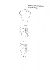 Способ лечения дефекта головки бедра (патент 2637290)