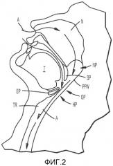 Система имплантатов и способы лечения обструктивного апноэ во сне (патент 2519960)