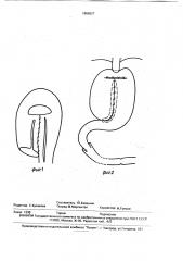 Способ тонкокишечной пластики при гастрэктомии (патент 1806627)