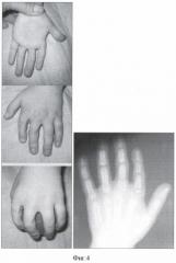 Способ лечения врожденного гиперфалангизма пальцев кисти (патент 2359628)