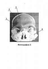 Имплантат для протезирования костей черепа и способ изготовления имплантата для протезирования костей черепа (патент 2638894)