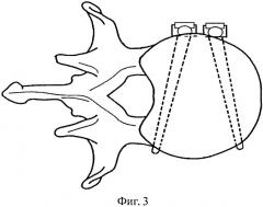 Способ остеосинтеза позвоночника при травмах и заболеваниях (патент 2559275)