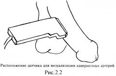 Способ диагностики васкулогенной эректильной дисфункции (патент 2336820)