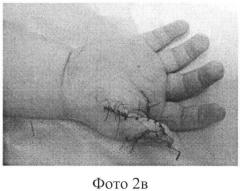 Способ реконструкции первого пальца кисти при врожденной полидактилии (патент 2577946)