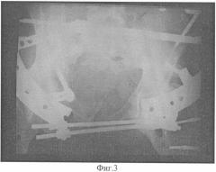Способ лечения больных с неправильно сросшимися множественными переломами костей таза (патент 2328998)