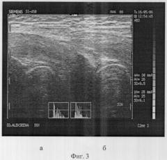 Способ ультразвуковой диагностики ранних стадий остеоартроза тазобедренного сустава (патент 2321350)