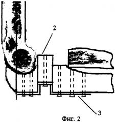 Способ лечения застарелого перелома-вывиха в локтевом суставе (патент 2289338)