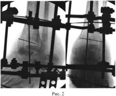 Способ артродеза голеностопного сустава при асептическом некрозе таранной кости (патент 2545984)