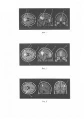 Способ диагностики нейродегенеративного процесса при болезни паркинсона (патент 2581252)