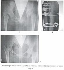 Способ стабилизации тазобедренного сустава при отсутствии головки и шейки бедренной кости с одновременным удлинением бедра (патент 2370228)