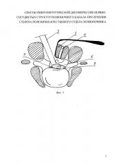 Способ микрохирургической декомпрессии нервно-сосудистых структур позвоночного канала при лечении стеноза пояснично-крестцового отдела позвоночника (патент 2628653)