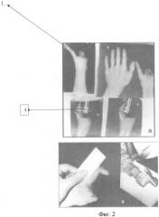 Способ формирования подвижности в суставе пальца при подготовке к протезированию (патент 2391067)