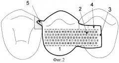 Способ замещения единичного отсутствующего зуба волоконно-композитным несъемным адгезивным мостовидным протезом (патент 2320292)