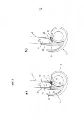 Деталь протеза (патент 2645277)