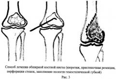 Способ лечения кистозной деструкции кости (патент 2456950)