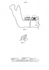 Устройство для фиксации отломков нижней челюсти (патент 1461438)
