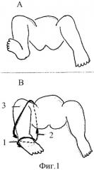 Способ лечения врожденных плосковальгусных деформаций стоп у детей первого полугодия жизни (патент 2299718)