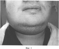 Способ оперативного лечения разлитых и гнилостно-некротических флегмон дна полости рта (патент 2328230)