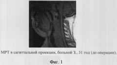 Способ оценки результатов лазерной увулопалатопластики у пациентов с феноменом храпа (патент 2301620)