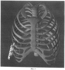 Способ и устройство для фиксации и репозиции множественных переломов ребер и грудины (патент 2497475)