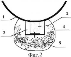 Способ проведения микроинвазивной непроникающей глубокой склерэктомии (патент 2548795)