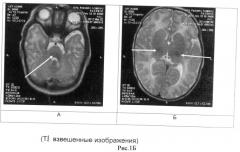 Способ определения зрелости церебральных структур у недоношенных новорожденных (патент 2491888)