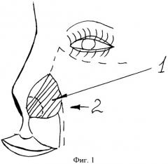 Способ хирургического лечения сквозного дефекта крыла носа (патент 2394511)