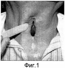 Способ восстановления дыхательной функции гортани и трахеи после формирования ларинготрахеостомы или трахеостомы (патент 2539536)