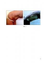 Малоинвазивный способ укрепления и сокращения кожи и подкожной клетчатки передней брюшной стенки человека (патент 2631644)