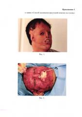 Способ наложения вакуумной повязки на голову (патент 2651057)
