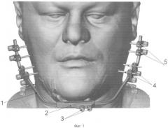 Внеротовое устройство для анатомического позиционирования фрагментов челюстных костей (патент 2541055)