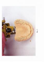 Способ изготовления детской индивидуальной защитной зубной шины (детская капа) (патент 2652549)