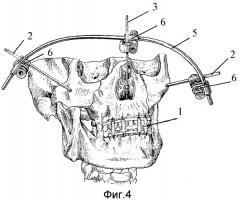 Способ внеочагового-стержневого остеосинтеза при переломах верхней челюсти по типу ле-фор - ii средний и комплект для его осуществления (патент 2430698)