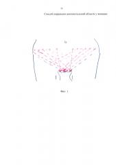 Способ коррекции аногенитальной области у женщин (патент 2638460)