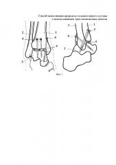 Способ выполнения артродеза голеностопного сустава с использованием трех спонгиозных винтов (патент 2633945)