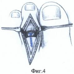 Способ межфалангового артродеза после коррекции ригидной молоткообразной деформации средних пальцев стопы (патент 2487683)