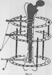 Устройство для лечения перипротезных переломов (патент 2324449)