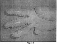 Способ кожной пластики при множественных повреждениях ладонной поверхности пальцев кисти (патент 2448656)
