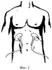 Способ хирургического лечения синхронного первично- множественного рака мочевого пузыря и предстательной железы (патент 2262308)