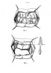 Способ ортопедического лечения зубочелюстных деформаций при пародонтите (патент 1701305)