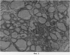 Способ восстановления функции щитовидной железы (патент 2290086)