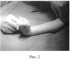 Способ лечения врожденной разгибательной контрактуры лучезапястного сустава у детей с артрогрипозом (патент 2506917)