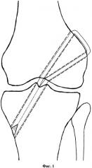 Способ пластики передней крестообразной связки коленного сустава у взрослых (патент 2506057)