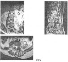 Способ диагностики натечных абсцессов при туберкулезном спондилите на низкопольном магнитно-резонансном томографе (патент 2255653)