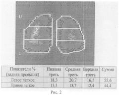 Способ диагностики инфильтративного туберкулеза легких, протекающего на фоне хронической обструктивной болезни легких (патент 2562714)