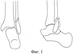 Способ лечения сложных пронационно-эверсионных переломов дистального суставного отдела костей голени (патент 2551303)